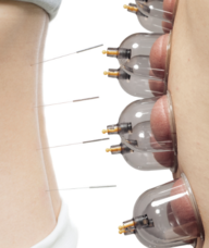 Book an Appointment with Acupuncture Studio for Acupuncture & Cupping